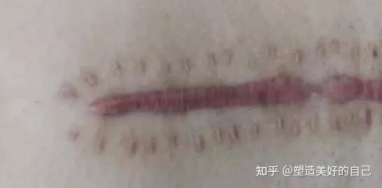 这些伤口愈合的必须知识,你知道吗?星疤克伤口护理软膏带你了解 - 知乎