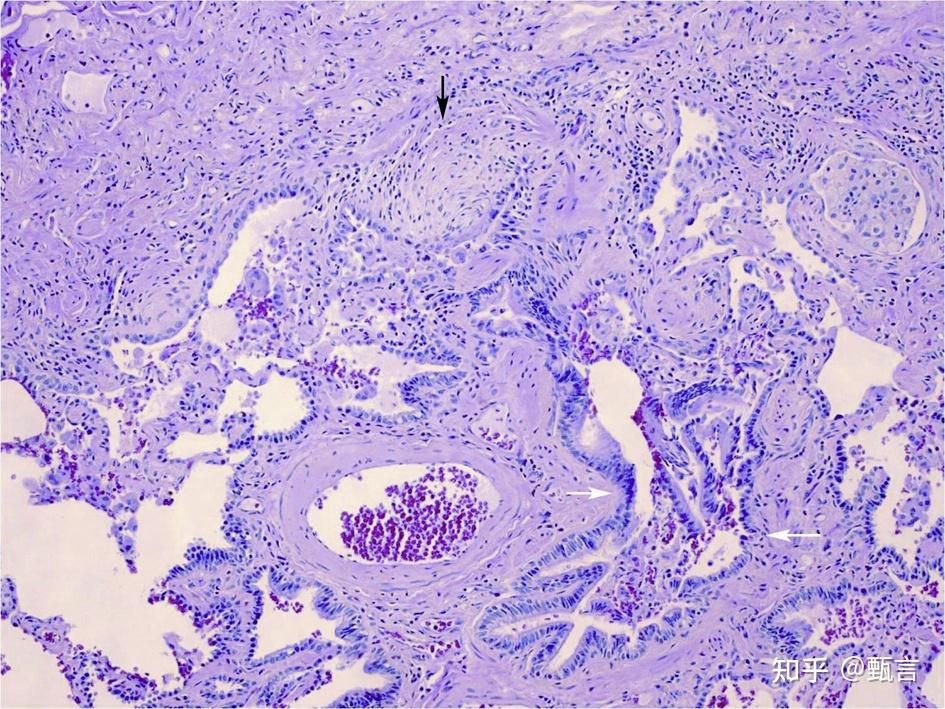 《ipf指南》药物治疗比较虽然吡非尼酮与尼达尼布已经用于ipf临床治疗