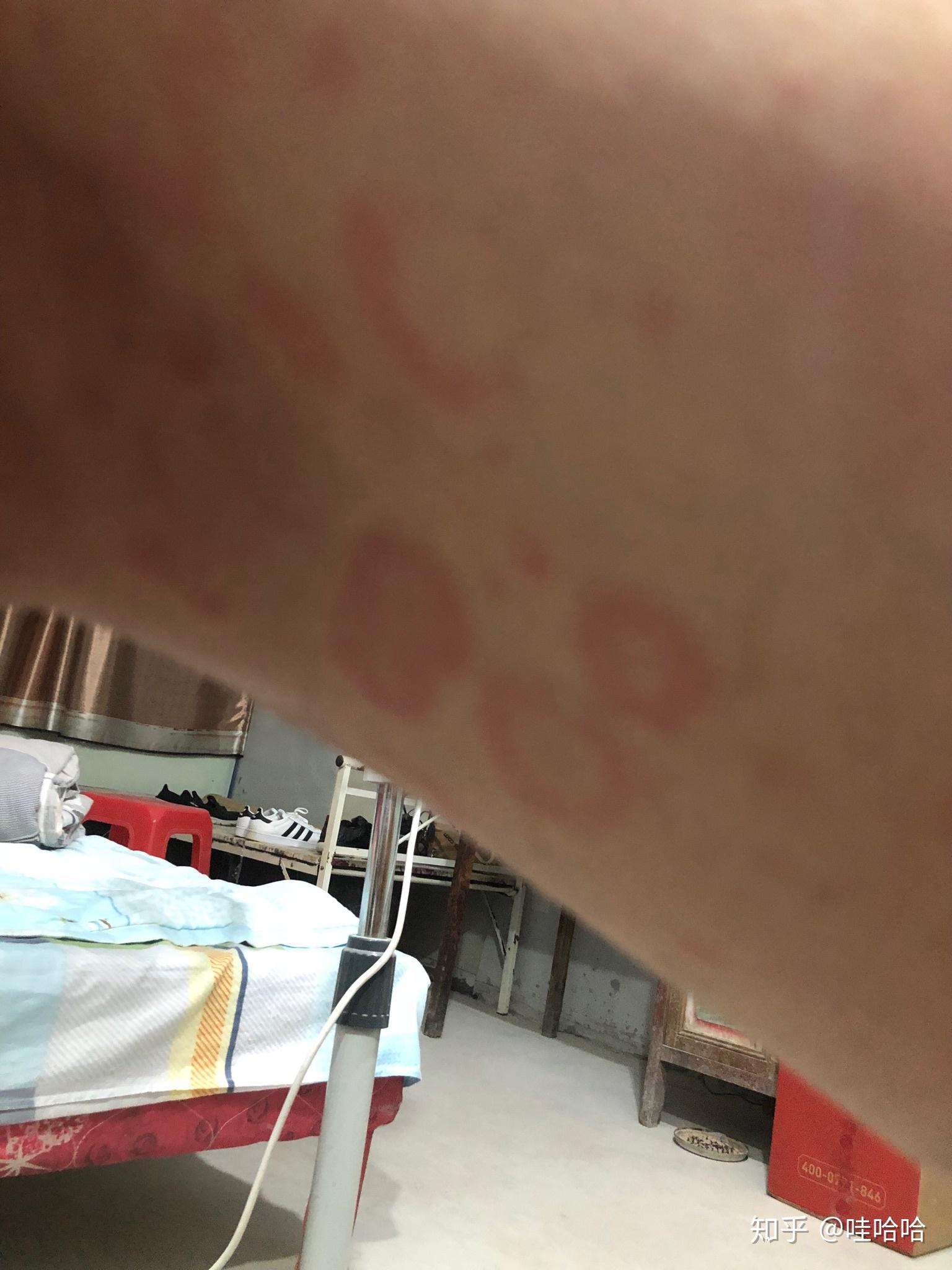 玫瑰糠疹是这样的吗