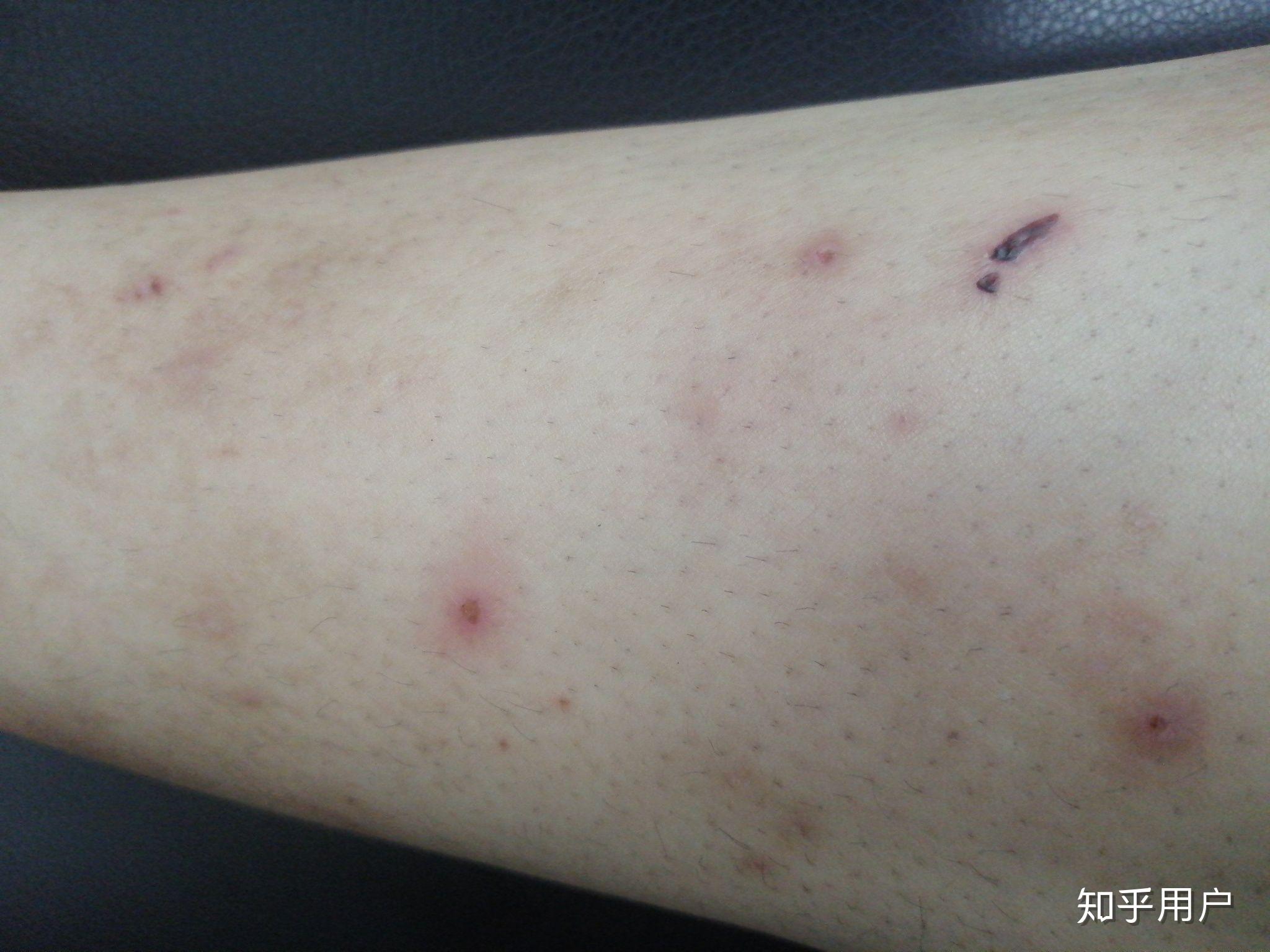 多年湿疹现在18岁腿上手上留下挺多的疤痕有什么办法治疗