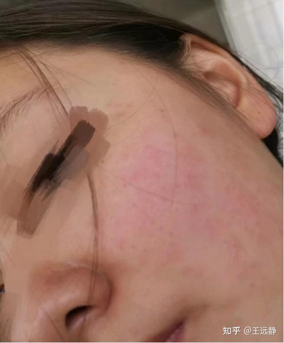 亲们, 脸干 起皮 爱泛红 角质层变薄了用什么护肤品?谢谢了?
