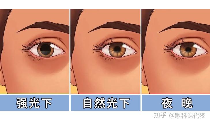 论近视手术后遗症眩光可怕吗杭州眩光最全指导解答