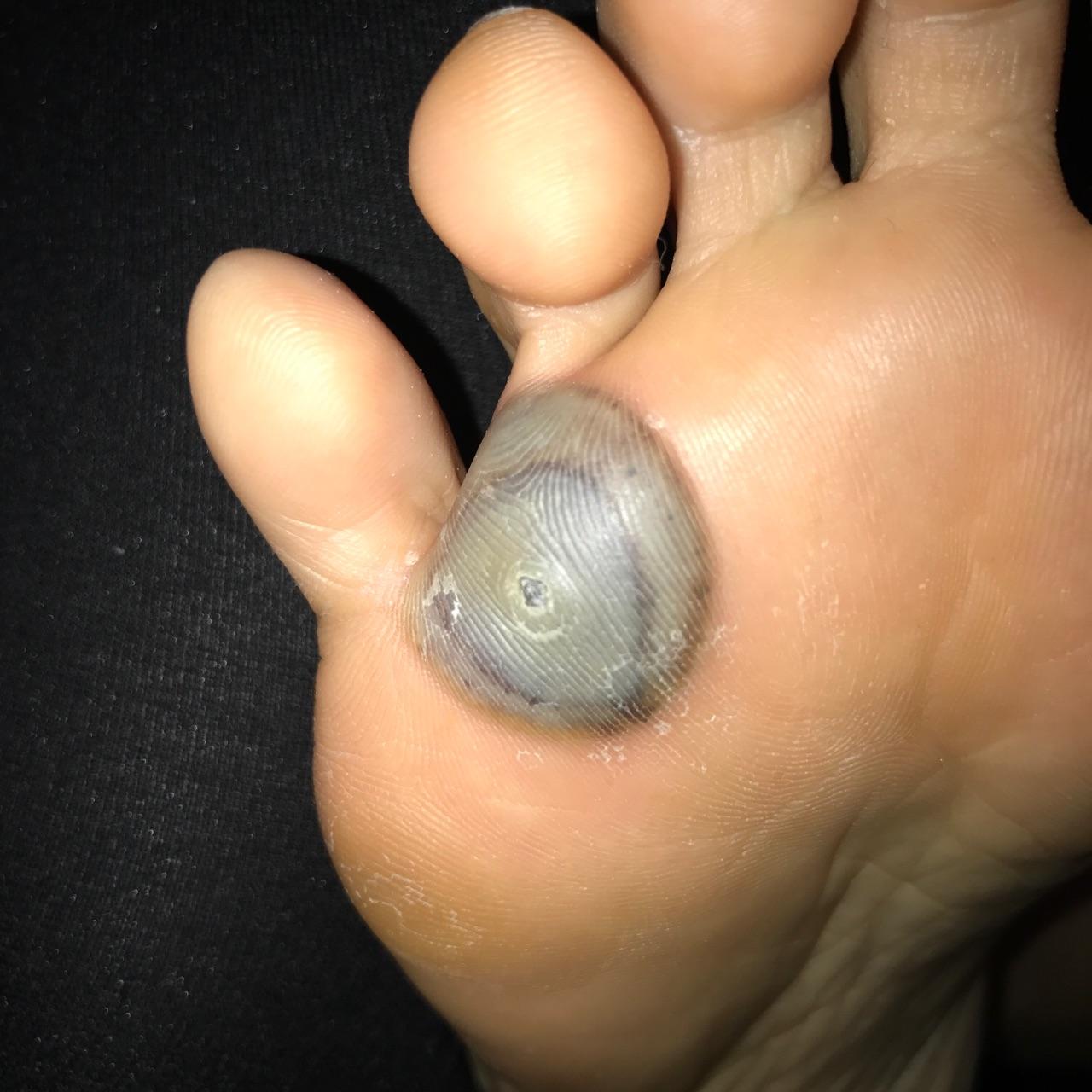 治疗手指上的寻常疣鱼鳞痣有什么办法或者药物