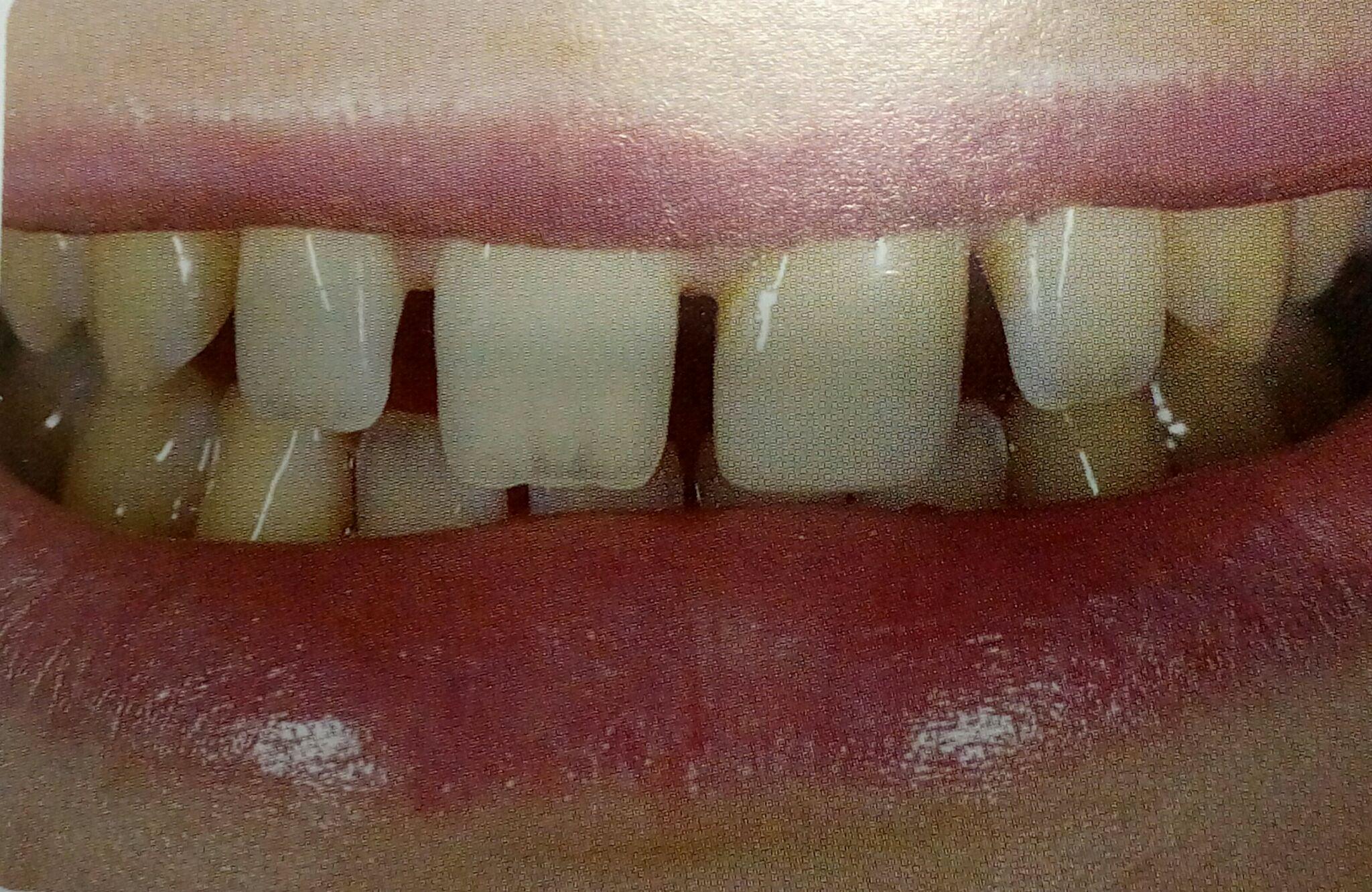 我门牙有大缝隙不知道怎么处理好? - 知乎