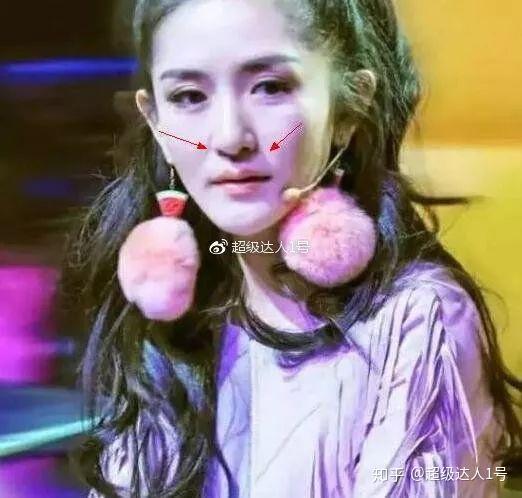 谢娜林允儿赵本山同款月亮脸都是鼻基底凹陷的锅