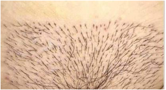 阴毛很直正常吗