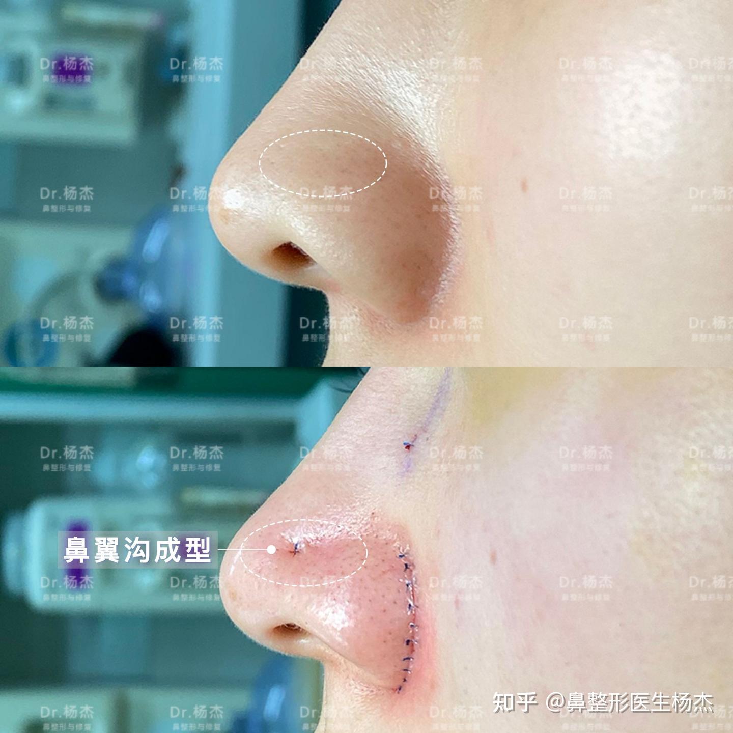 【外切鼻翼缩小+鼻翼沟成型+鼻骨内推】 - 知乎