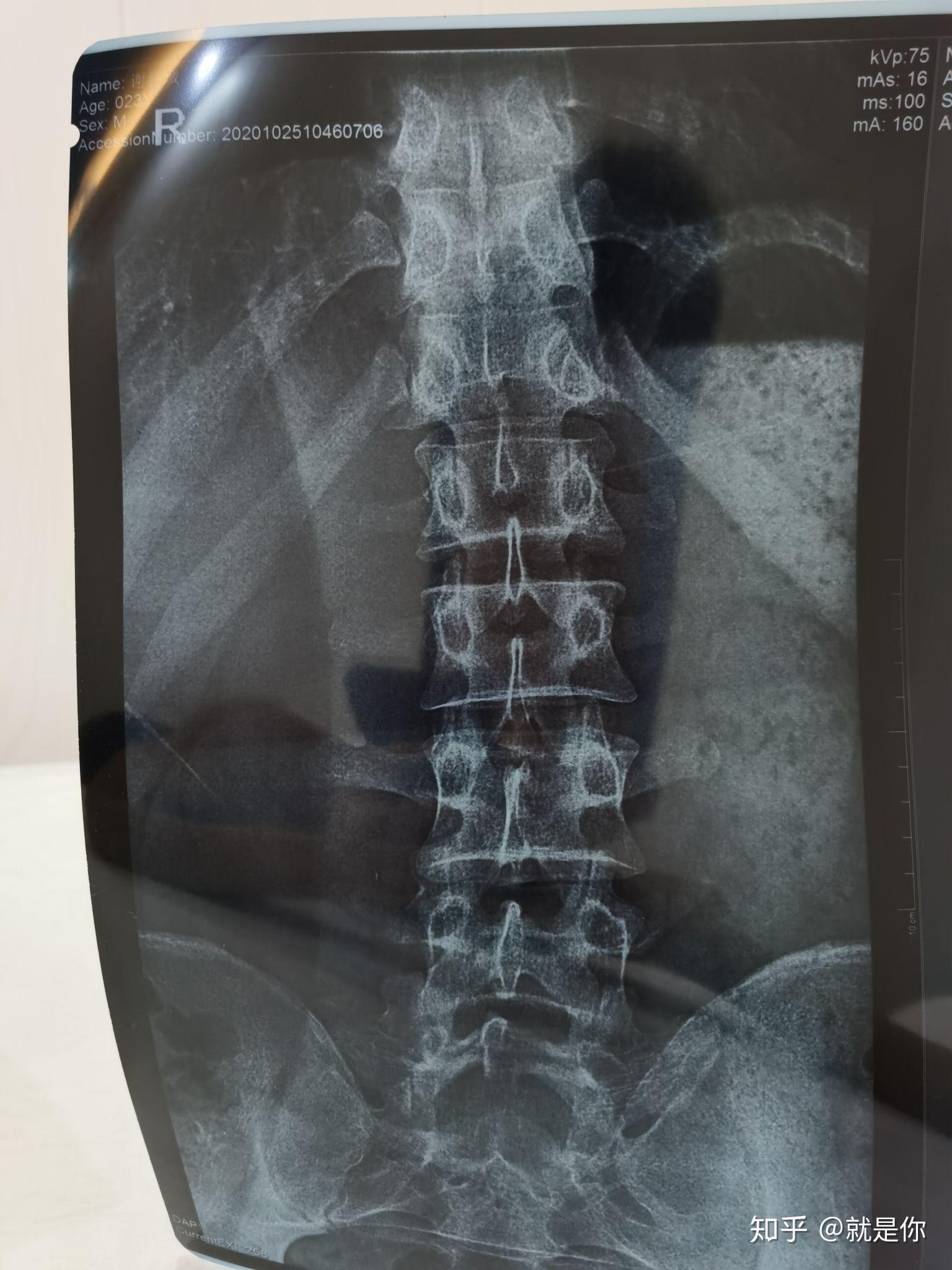 可自行矫正的脊柱侧弯的标准是什么轻度脊柱侧弯兵检可以通关吗