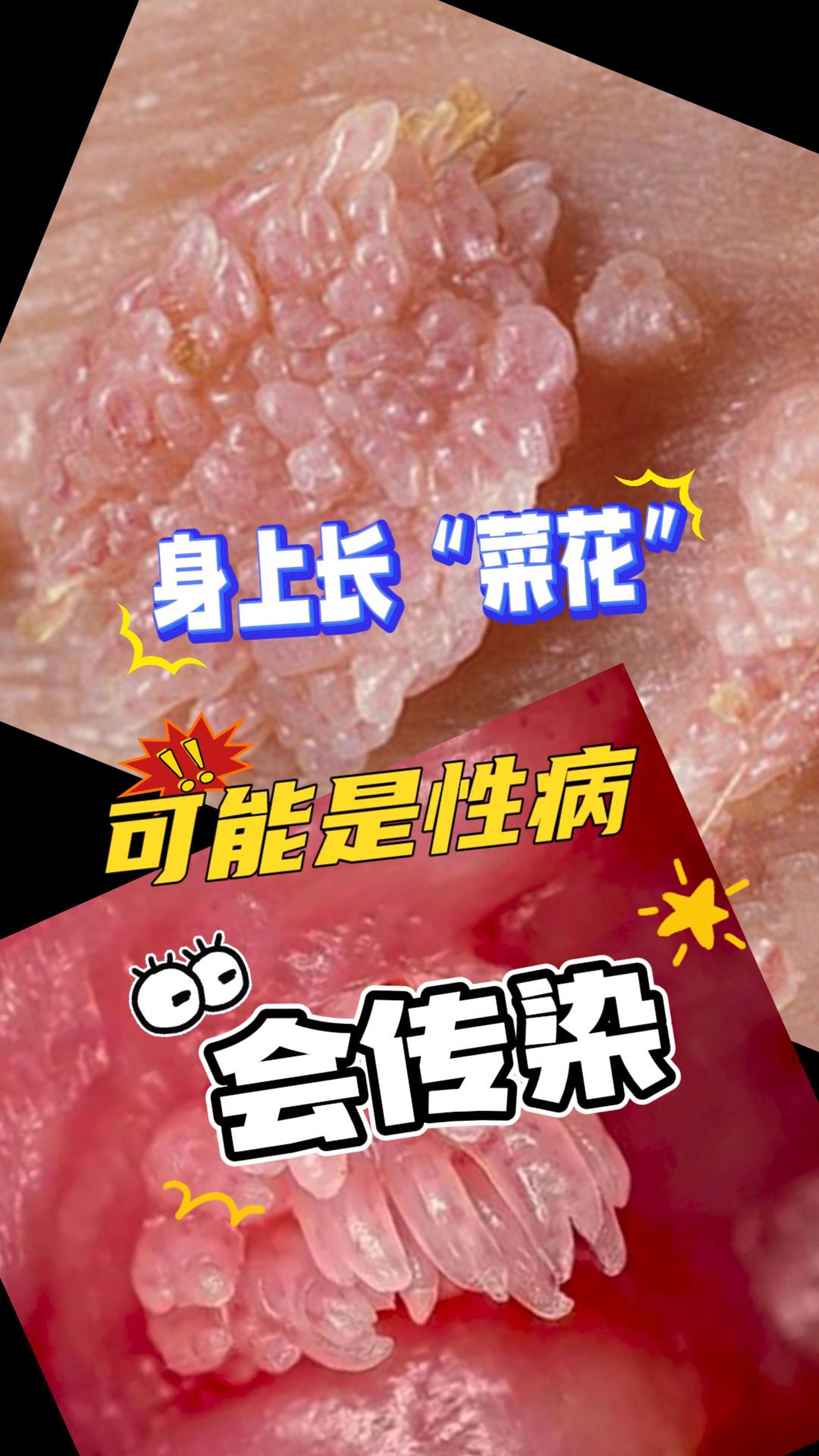 菜花状肉粒是什么原因图片