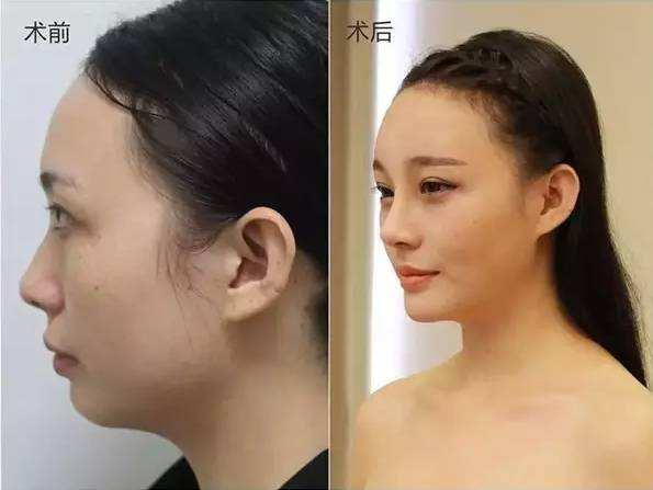 低鼻梁与高鼻梁的审美差距 - 知乎