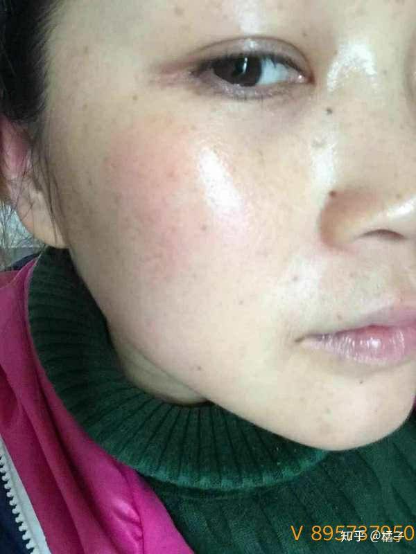 生孩子长妊娠斑被老公嫌弃该怎么办