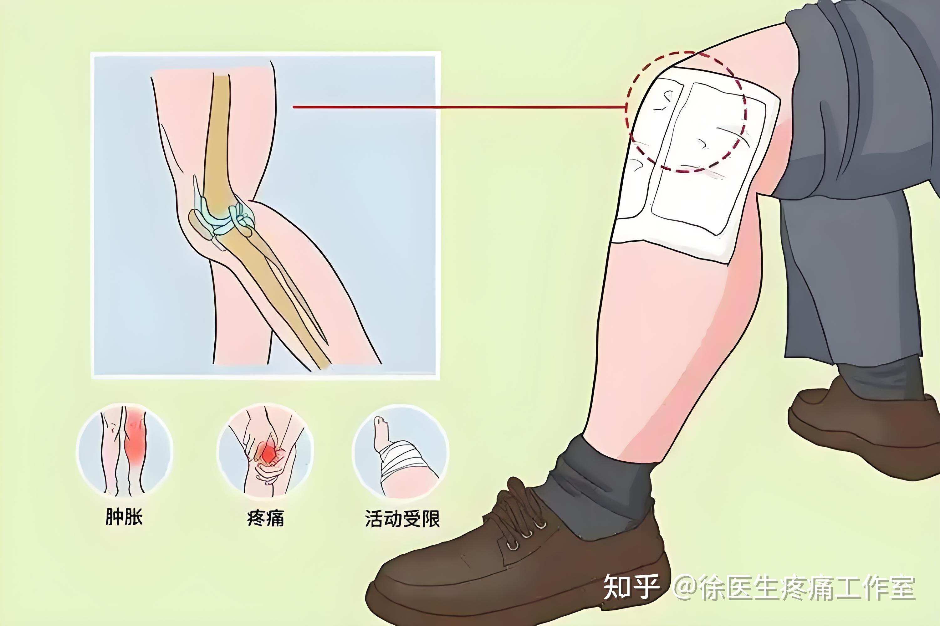 运动受伤别瞎敷！冰敷用错，越敷越伤，这些误区你踩了吗？ - 知乎