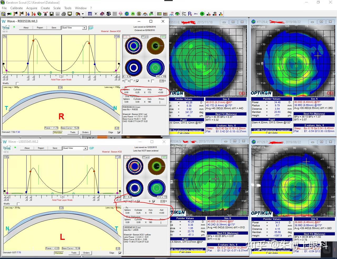 亲们对于眼轴长2721角膜曲率3938的12岁孩子角膜塑形镜哪个品牌的比较