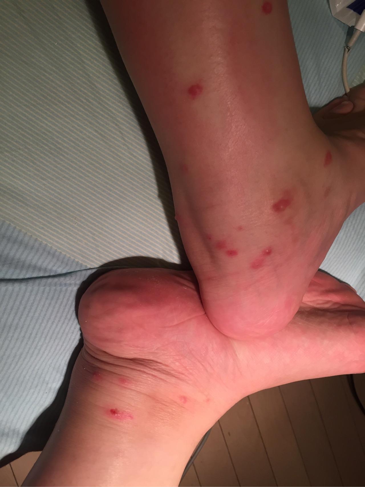 如何防止被黑蠓叮咬及叮后处理方法?