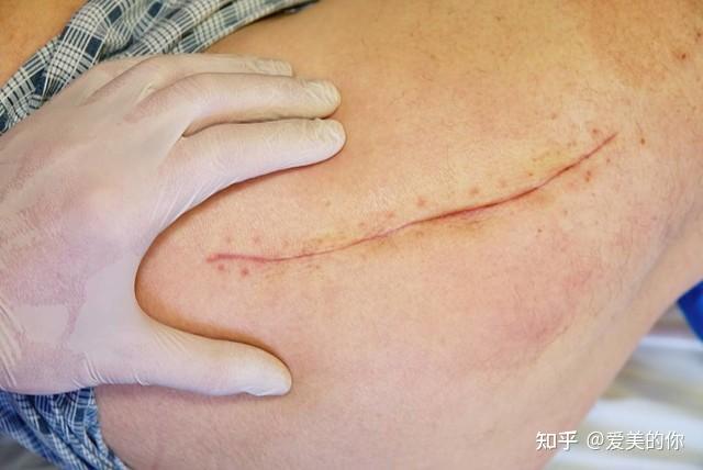 手术疤痕有没有办法修复改善