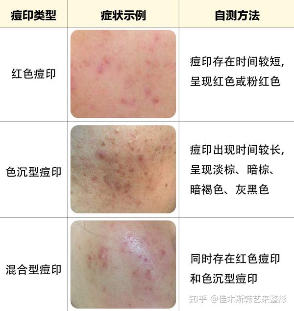 痘印的形成原因与治疗方法【韩艺来美丽分享】 - 知乎
