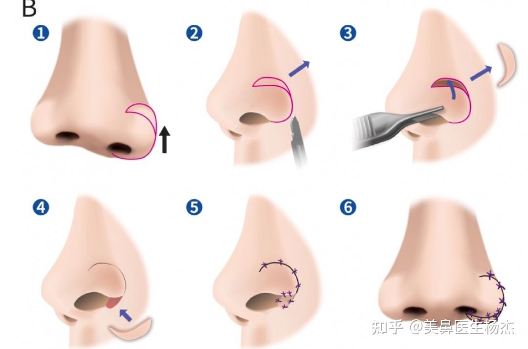 鼻翼下垂的分型以及治疗方法