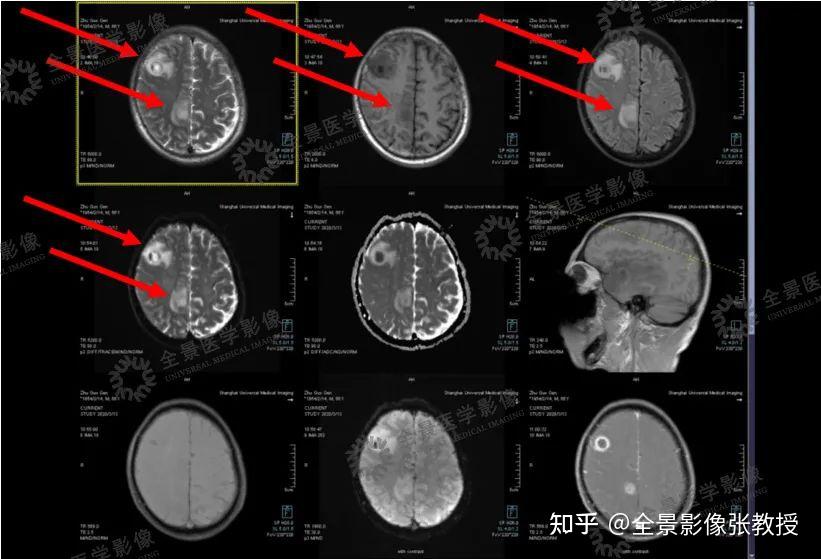 脑脓肿MRI图片