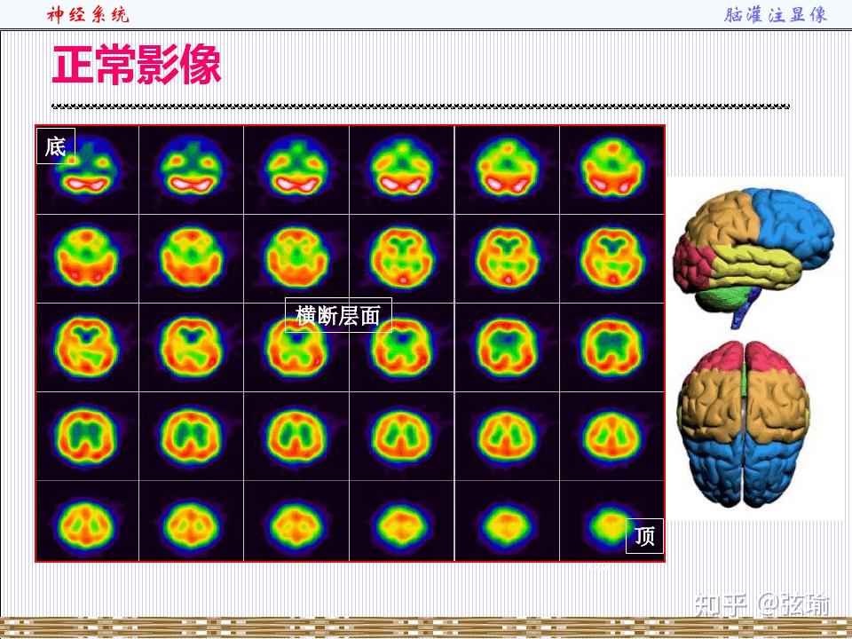 脑灌注成像颜色解读图片