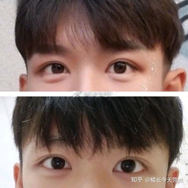 男生割双眼皮恢复一个月能达到可以出门见人的程度吗