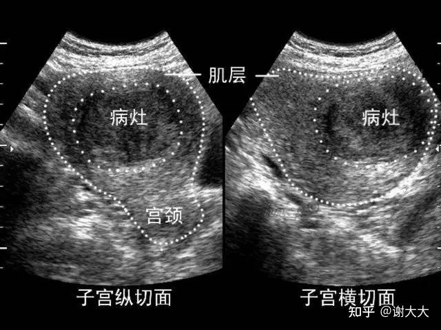 1,先治療:如果是子宮肌瘤的黏膜下肌瘤,影響宮腔的肌壁間肌瘤或者直徑