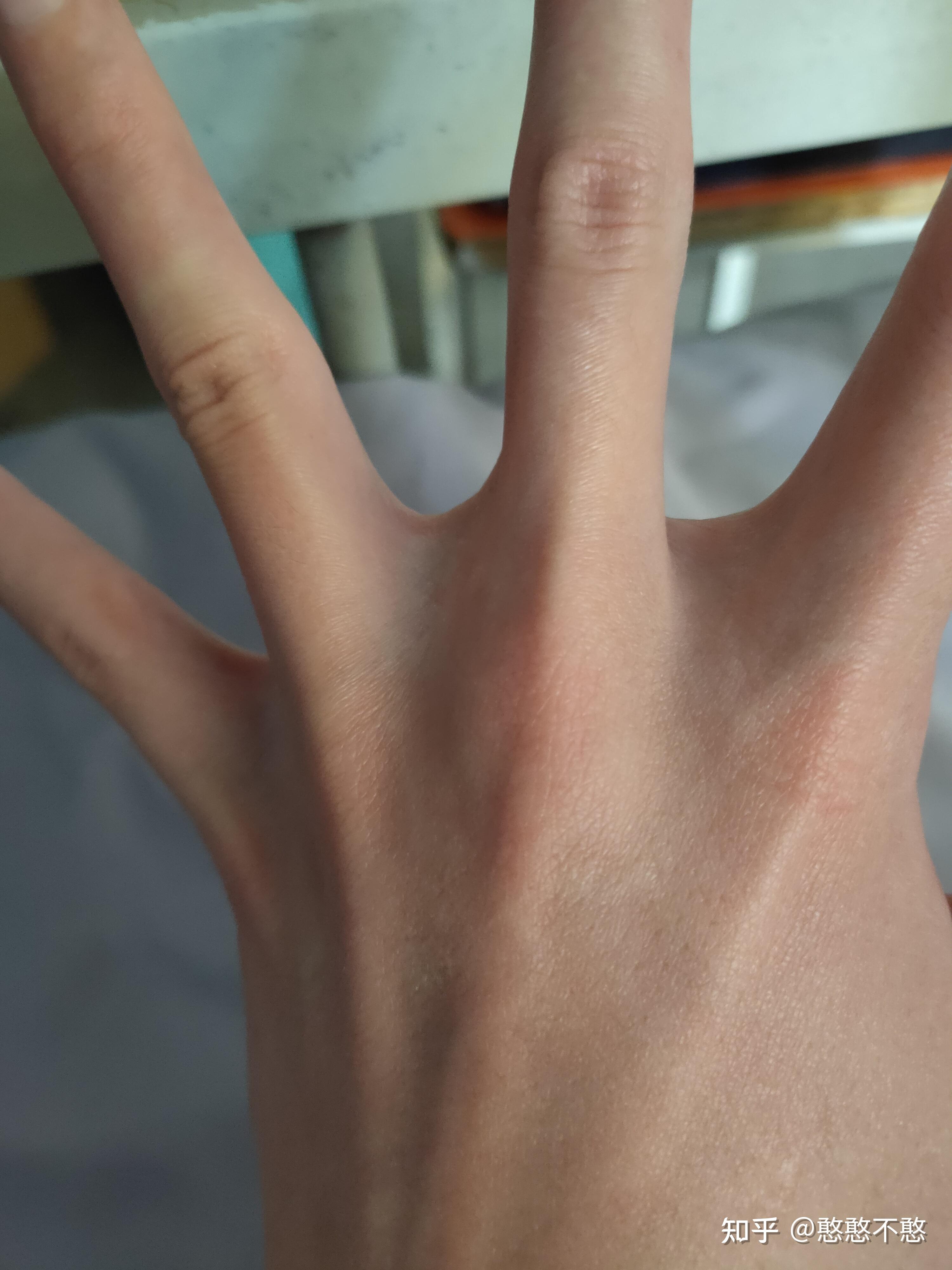 手指之间有点像蹼的东西是什么?为什么我的比别人的大许多? - 知乎