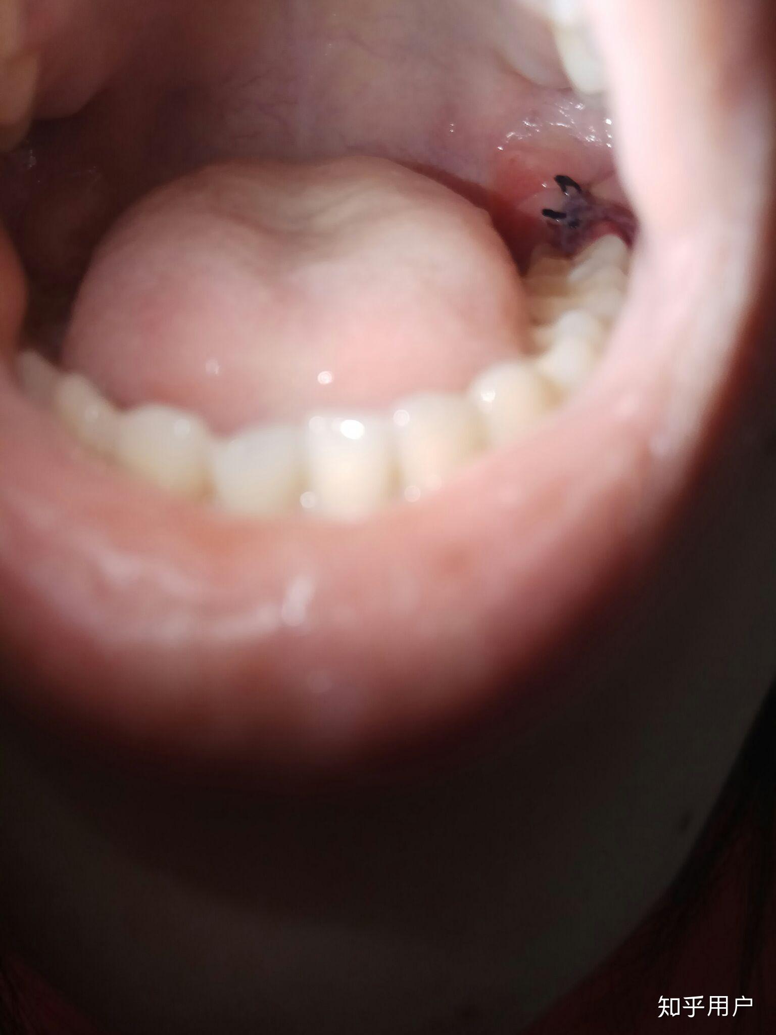 牙龈假膜图片
