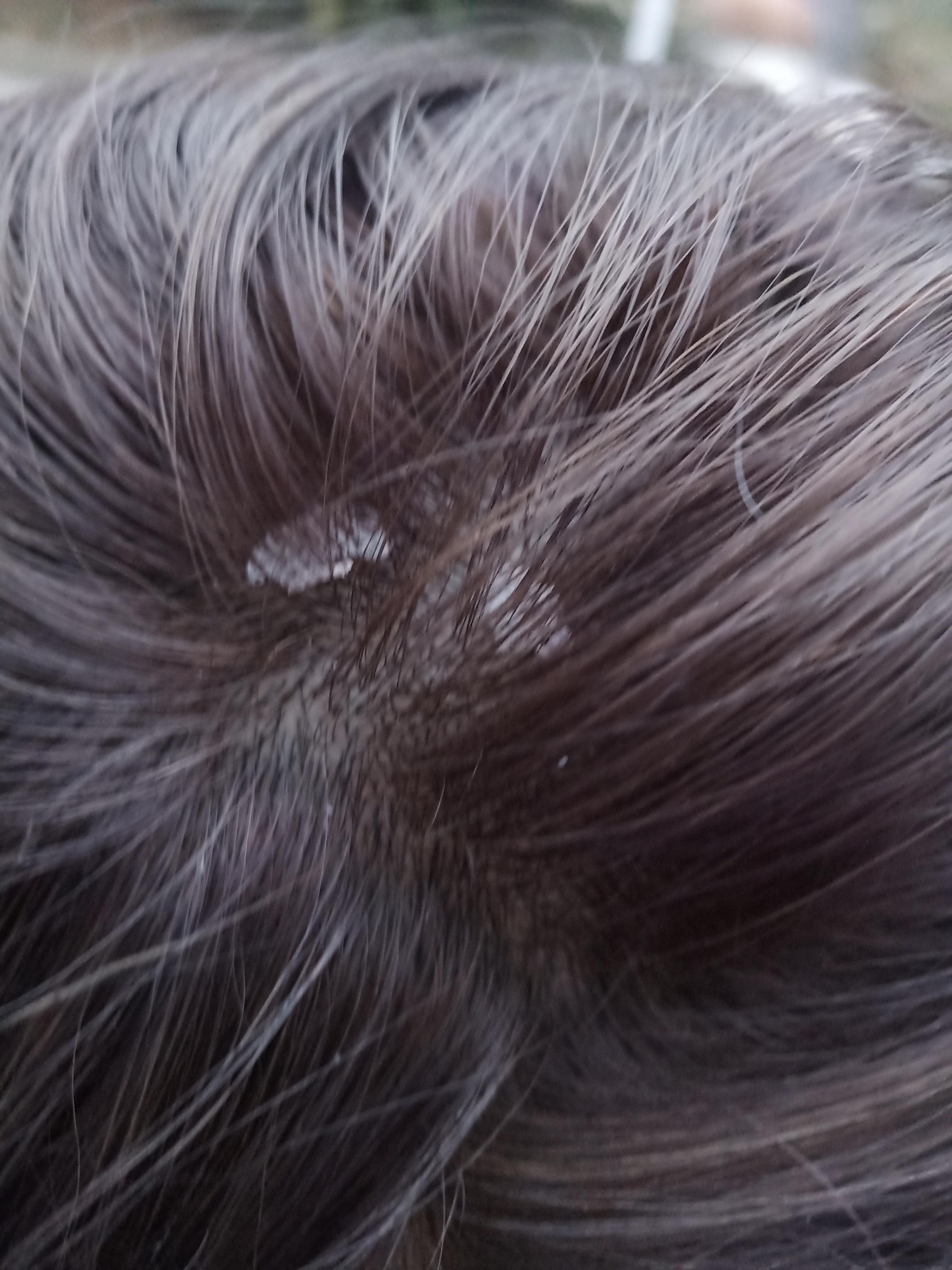 见过的最大头皮屑多大? - 知乎