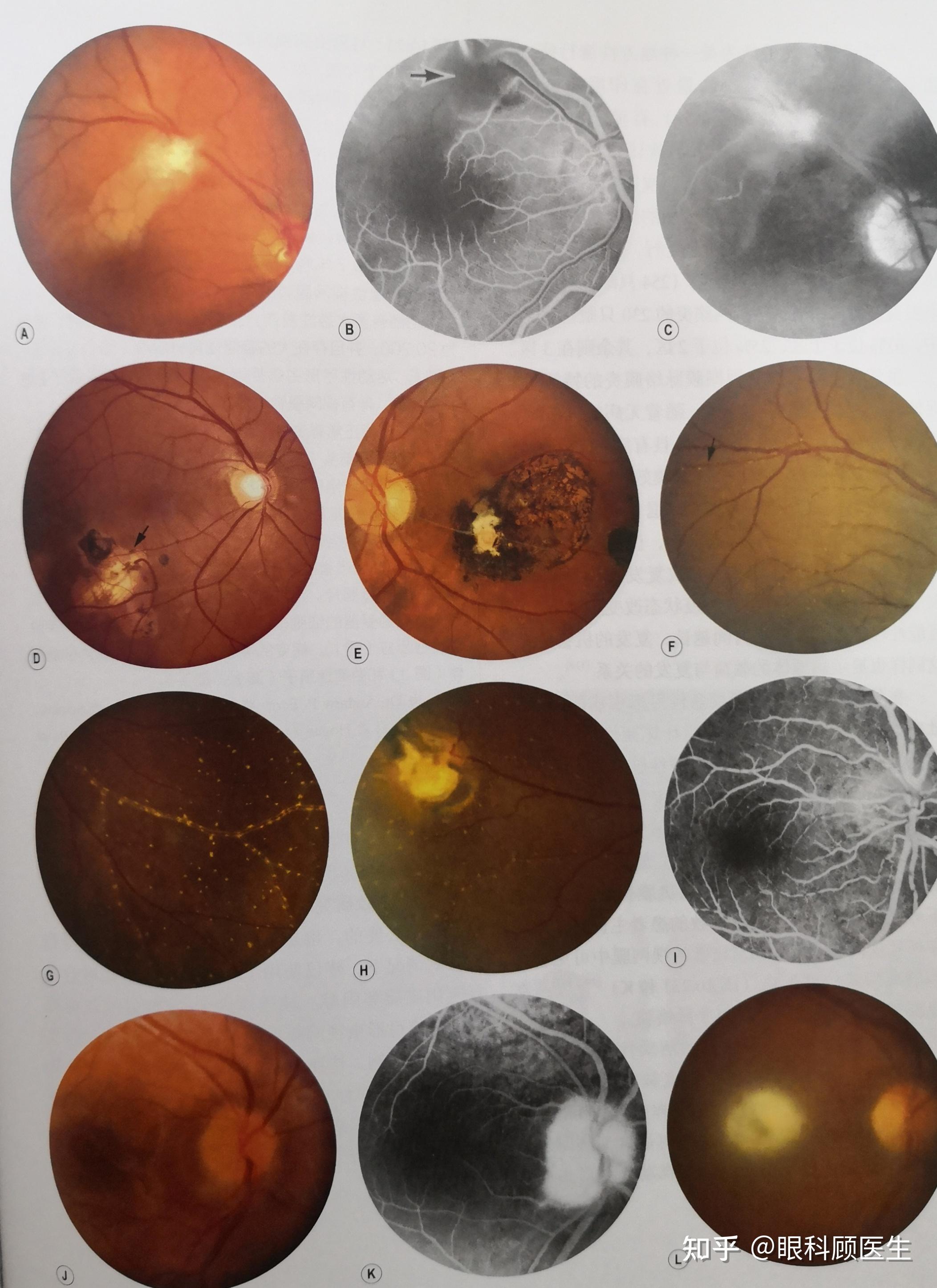 弓形虫病引起的视网膜脉络膜炎是什么样的? 