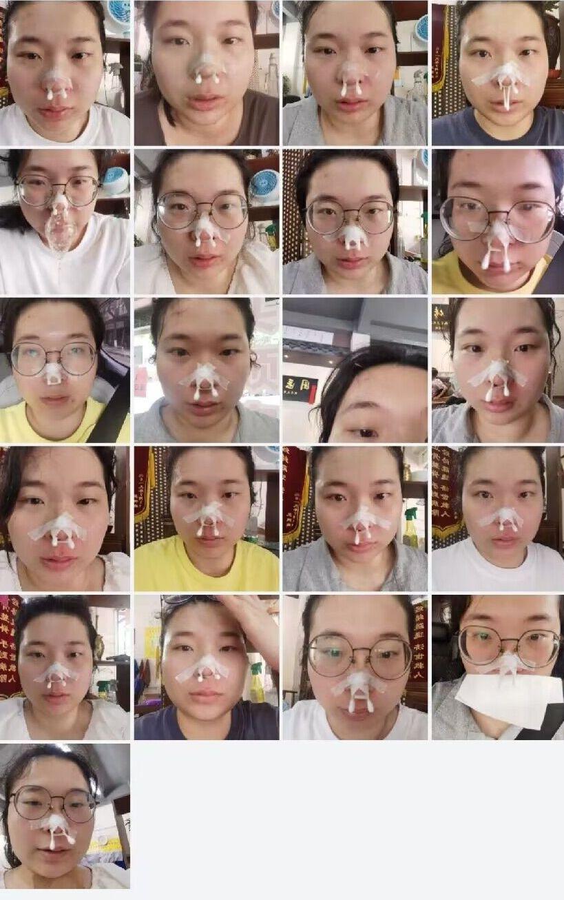 后来无意中听到别人说可以抽脓,就是插个麻醉棒,然后用巨长的钢针两个