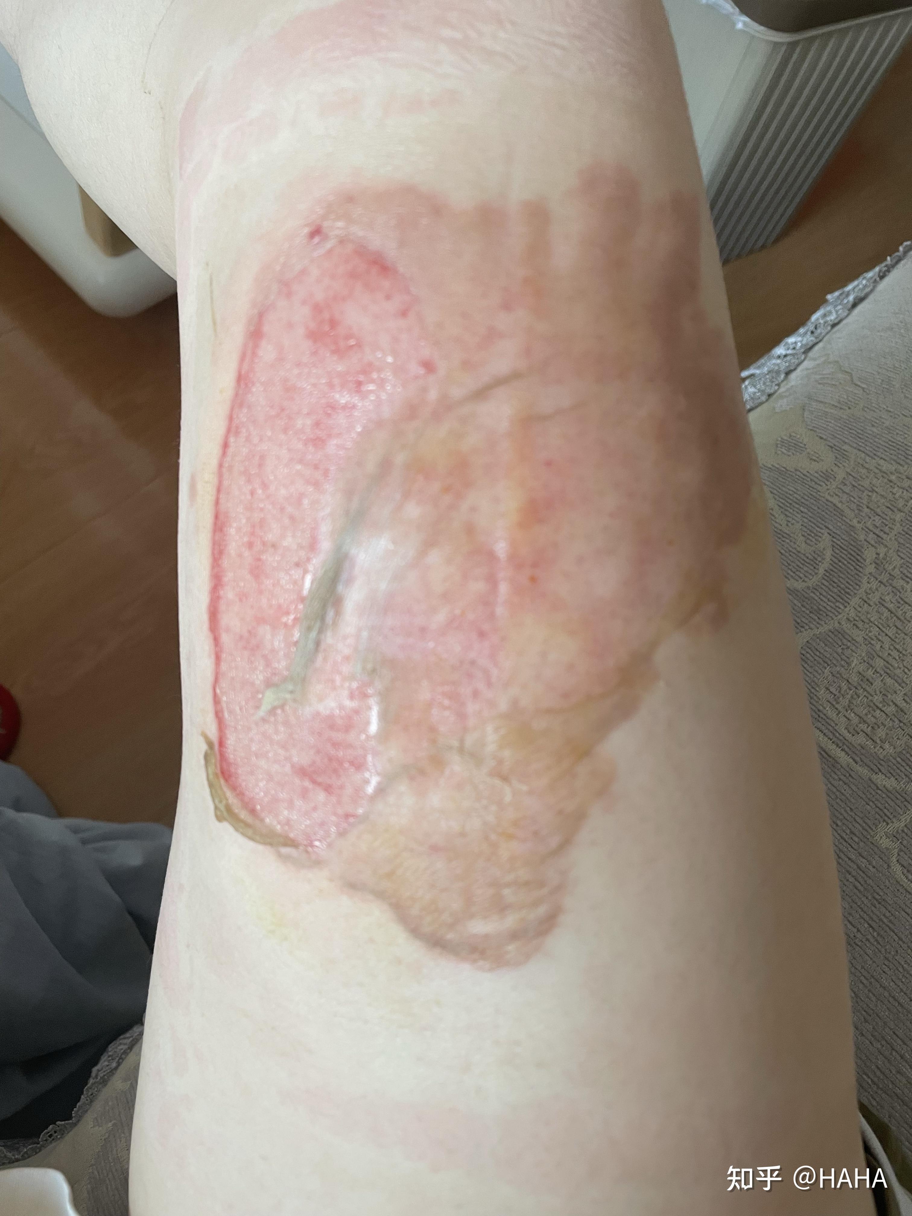 烫伤自我在家换药过程