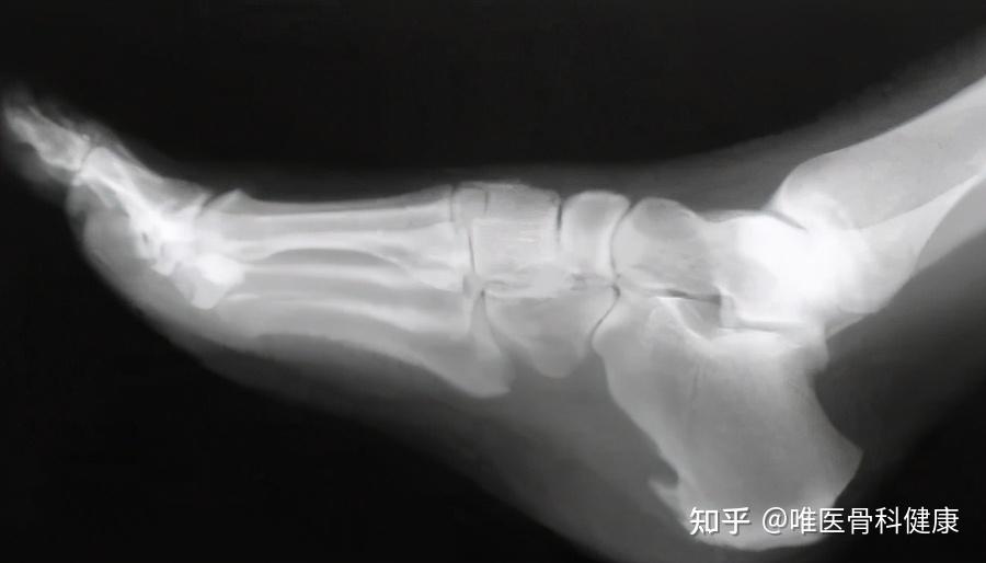 长骨刺了,要怎样处理?关键的是要从年轻就注意这 3 点! - 知乎