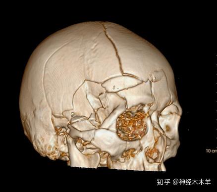 多学科联手,救治重型颅脑损伤一例! - 知乎