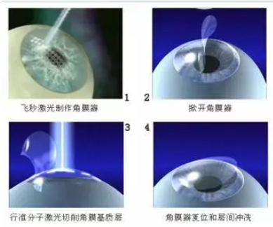 手术治疗近视眼的原理_MCT技术控制近视 非手术治疗近视的首选(3)