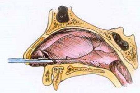 首大陈潜治疗鼻中隔脓肿要注意什么