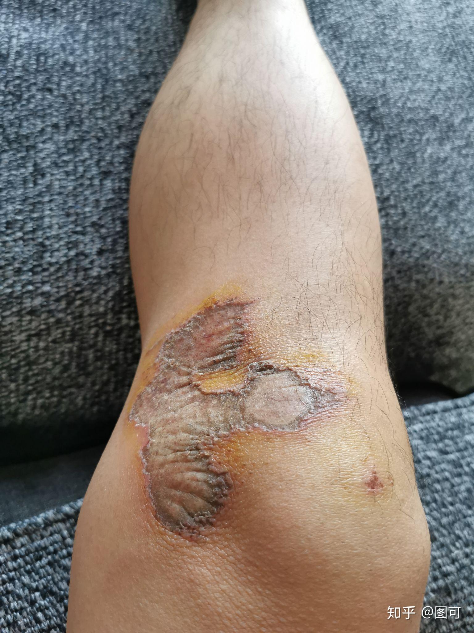 骑车侧翻膝盖摔伤破皮,怎么处理伤口,怎样才能不留疤? - 知乎