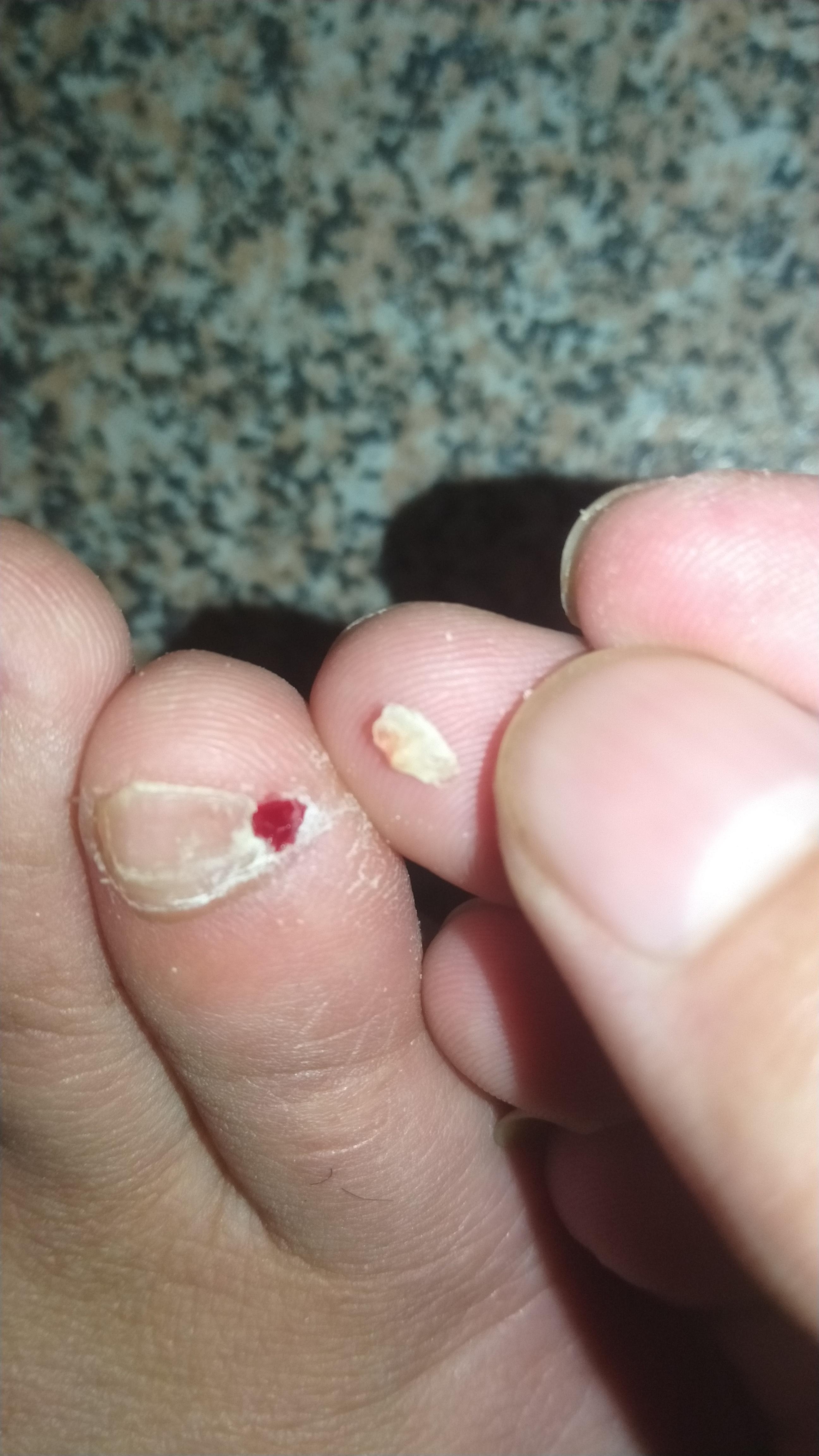小拇脚指指甲两瓣是怎么回事? - 知乎