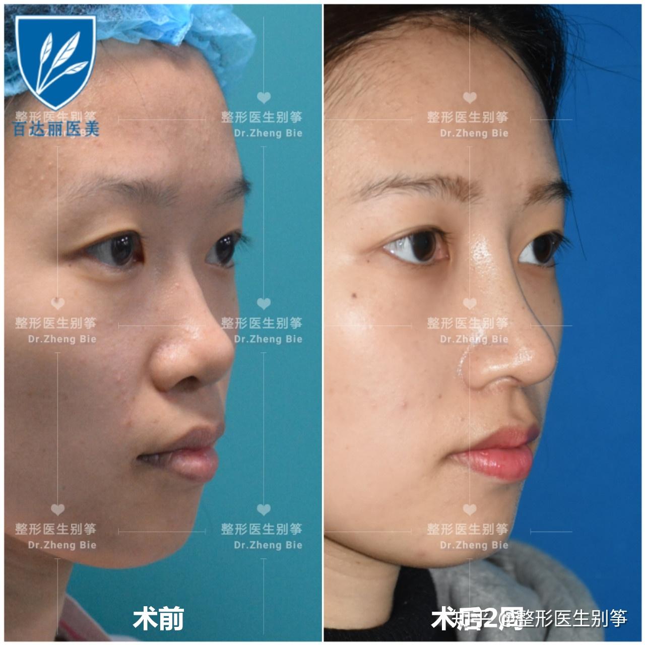 TACの鼻整形が人気の秘密｜症例写真・ビフォーアフター｜美容整形･美容外科のTAクリニックグループ