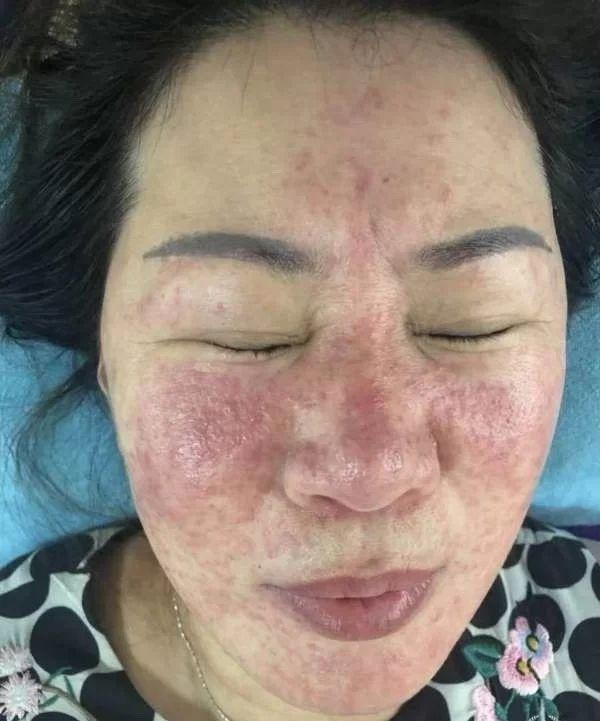 湿疹反反复复是因为你做错了这件事情
