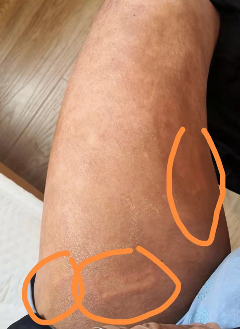 结节性血管炎的患友们,你们是怎么坚持的? - 知乎