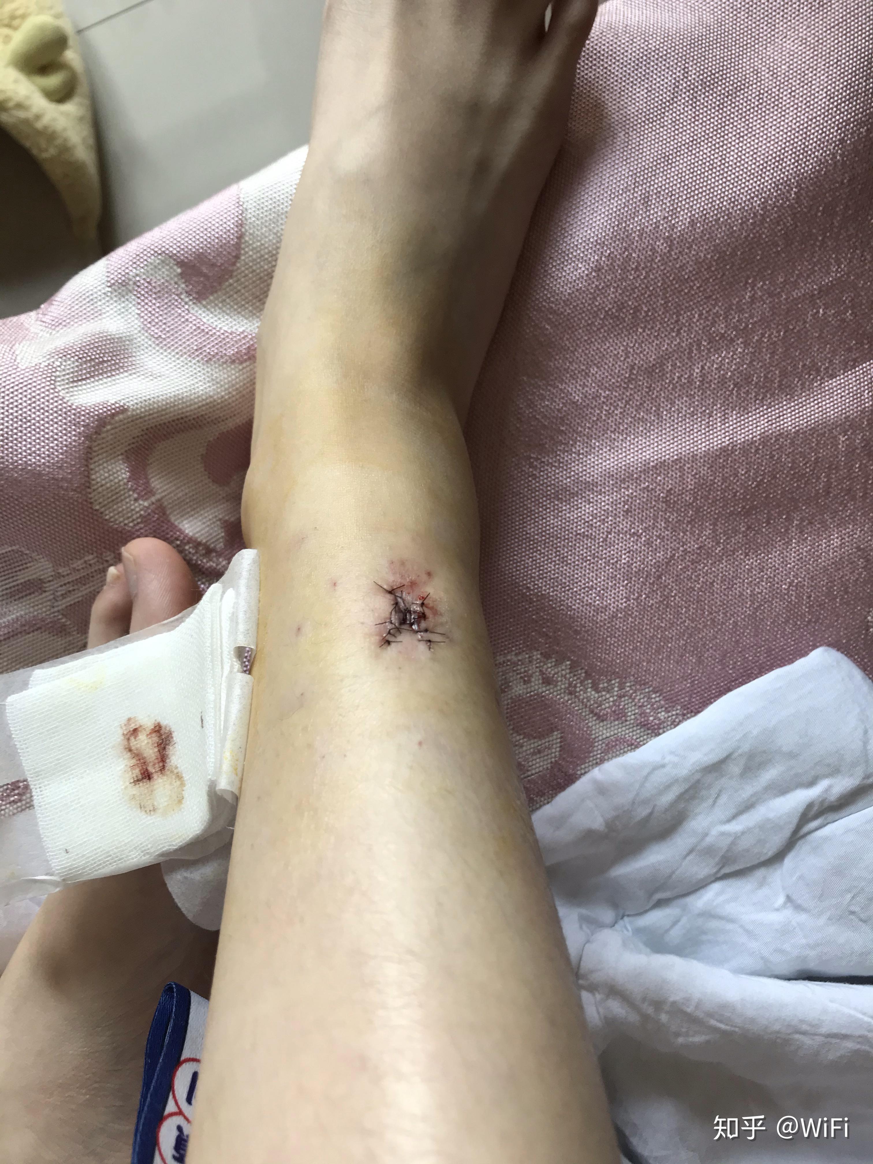 脚踝切痣手术皮瓣手术记录