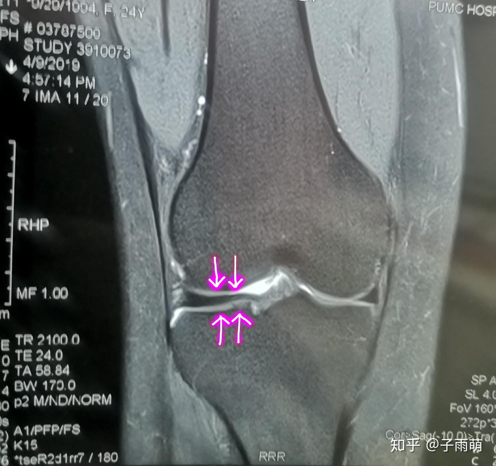 【knee膝最常见疼痛—髌骨软化】-健康160