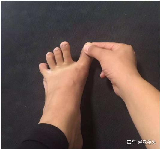 拇外翻、拇囊炎、大脚趾不灵活，是为什么呢？怎么解决？ - 知乎