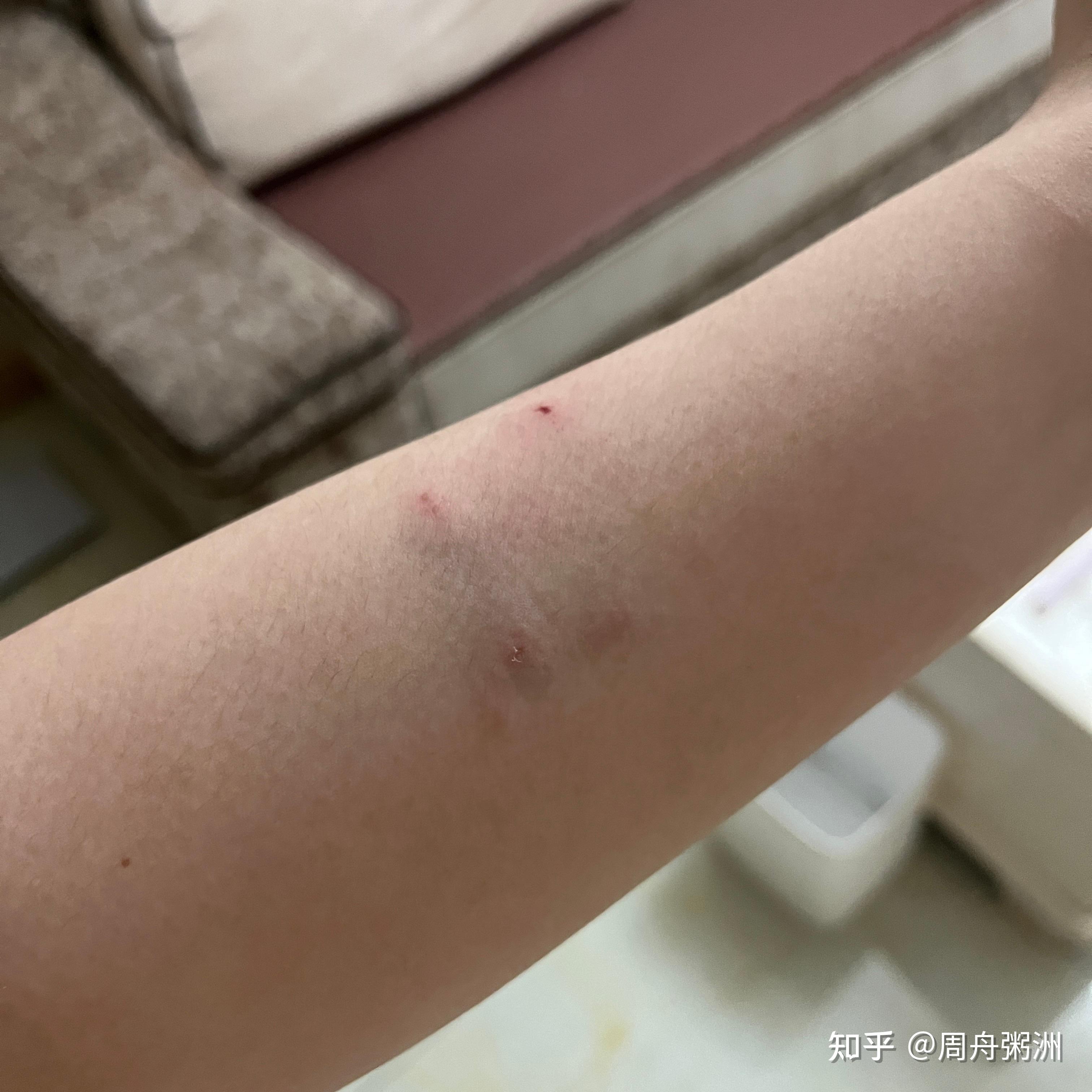 被家里的猫咬了四个洞 流了一点血 不准备打疫苗