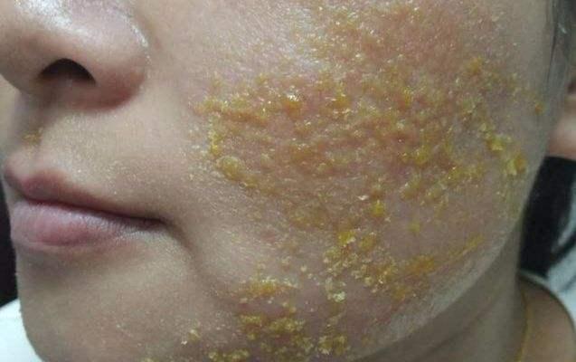 激素脸流黄水是什么原因结痂又丑又难受跟毁容没区别