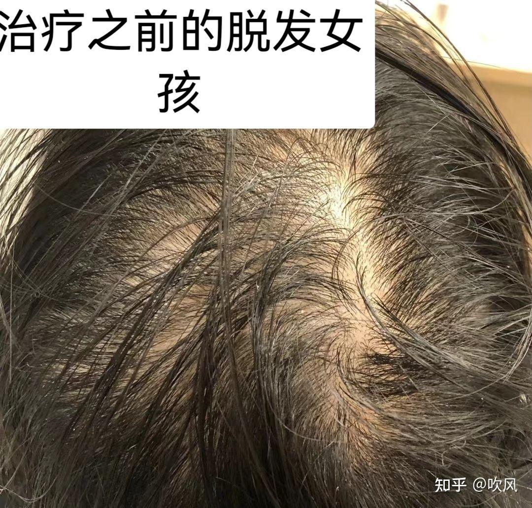 脱发女孩到发量女神 - 知乎