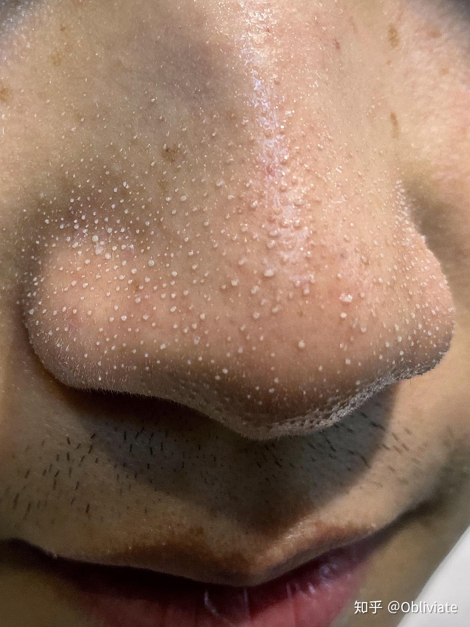 挤黑头鼻头会变大吗