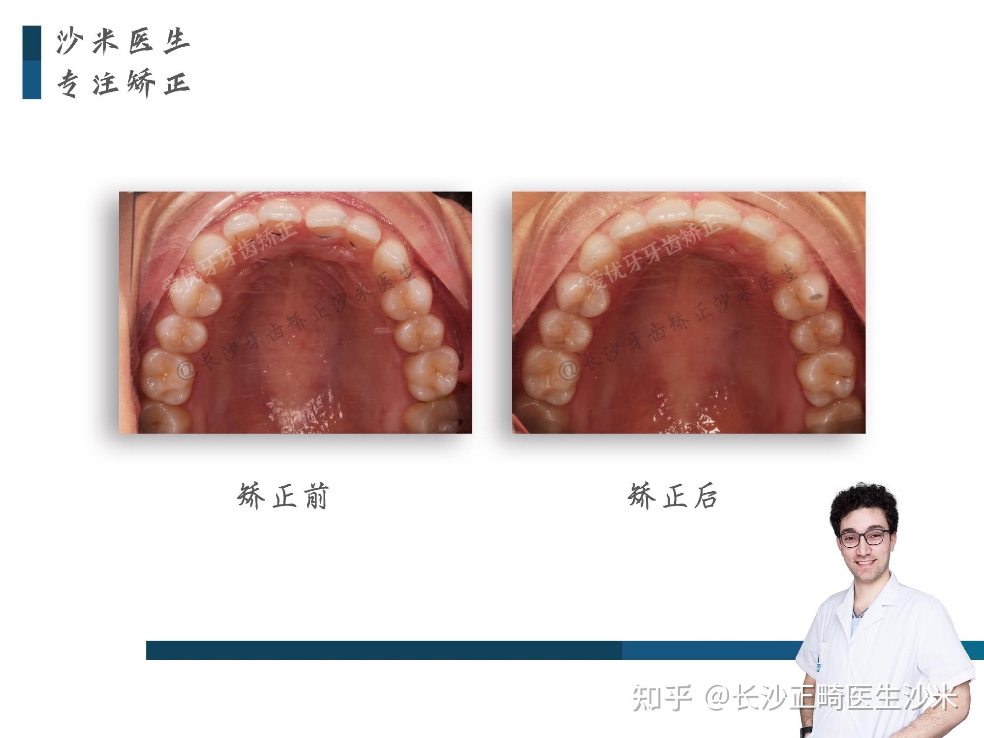 長沙牙齒矯正深覆合該如何矯正小朋友你是不是有很多問號