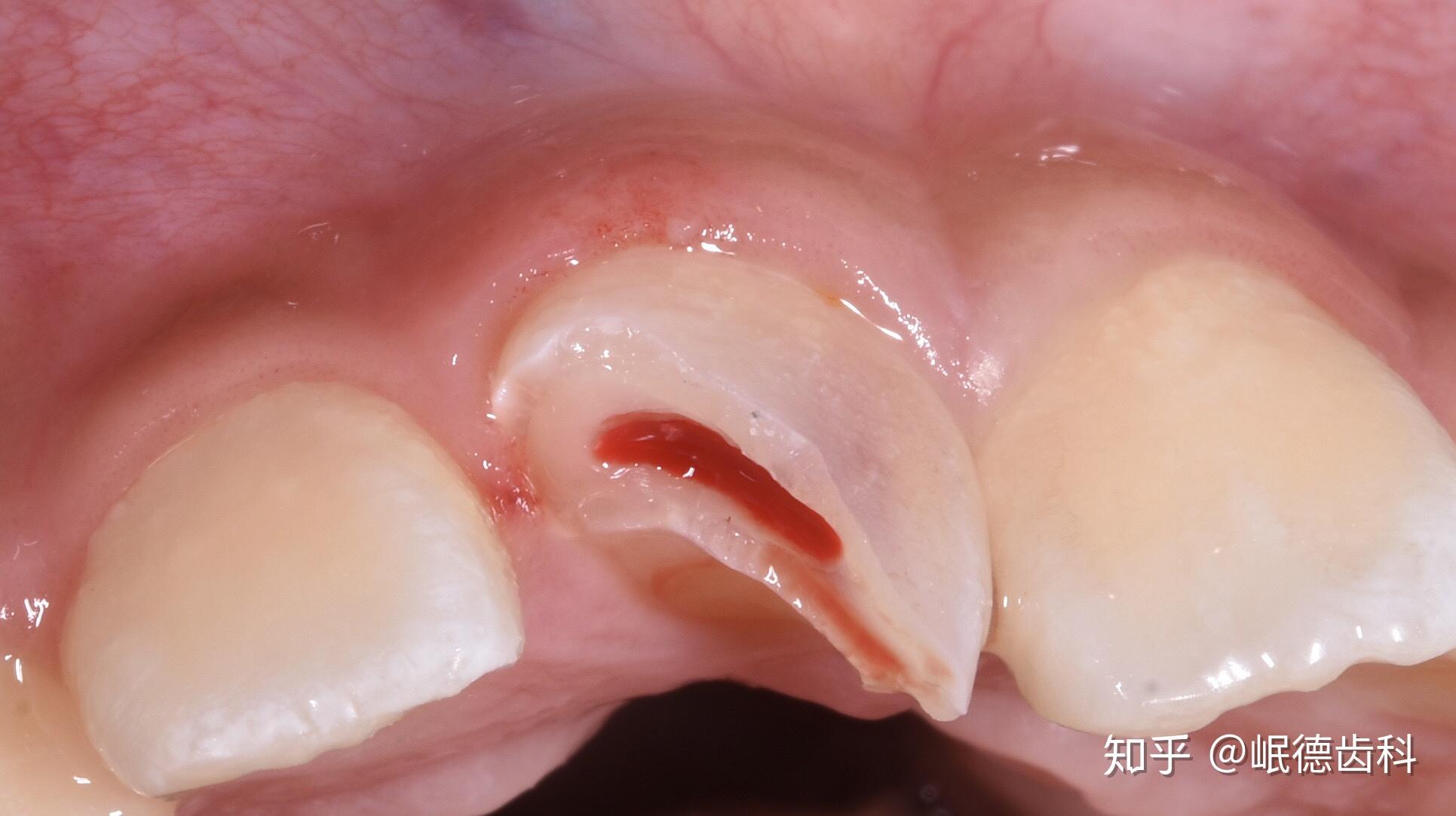 儿童牙外伤 - 知乎