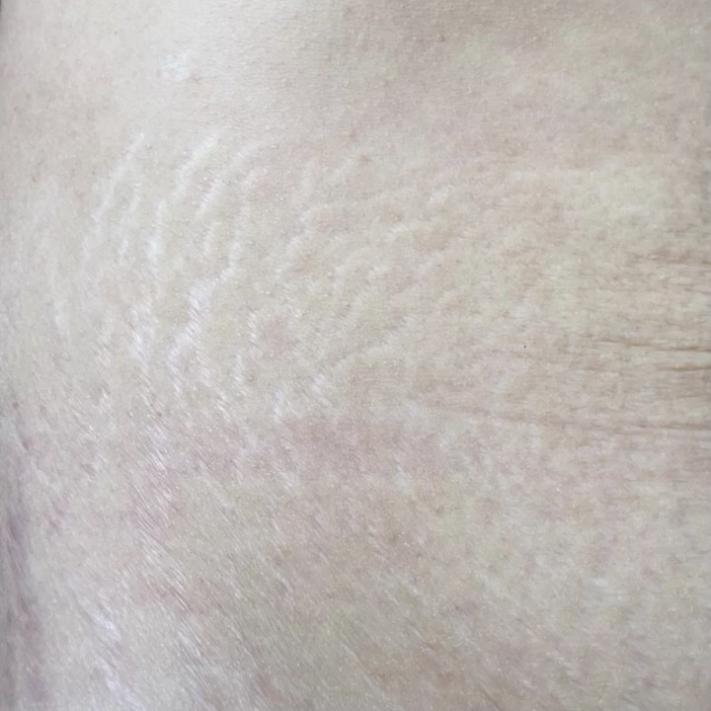 长妊娠纹是一种什么样的体验?